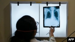 Seorang dokter tengah memeriksa rontgen dada pasien yang didiagnosis mengidap TBC, saat konsultasi rutin di klinik Médecins Sans Frontières (MSF) di Mumbai, 22 Maret 2022. (Punit PARANJPE / AFP)