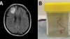 Living Worm Discovered in Australian Patient’s Brain 