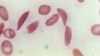 US Approves Two Treatments for Sickle Cell Disease
