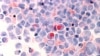 Progress in Childhood Cancer Has Stalled for Blacks and Hispanics, US Report Says 