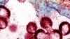 Scientists Disarm AIDS Virus’ Attack on Immune System