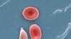 Cameroon Sickle Cell Patients Say They Can Live Longer