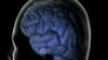 Blood Vessel Disease Linked to Dementia