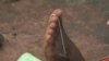 Carter Center Nears Goal Against Guinea Worm 