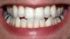 Fish Scales to Fangs: Surprising Tale of How Teeth Got Their Bite