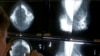 Low-dose Aspirin Might Reduce Risk of Most-common Breast Cancer 