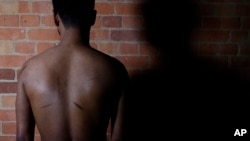 FILE - A Sri Lankan man known as Witness #205 shows the scars on his back during an interview in London, July 20, 2017.