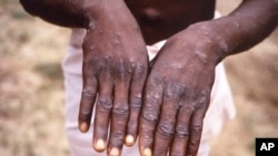 WHO Monkeypox