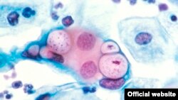 Cervical Cancer