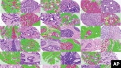 This image shows breast cancer images adjacent to matching images that have been automatically labeled by image processing software.