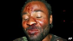 Mário Domingos, organizador de uma a manifestação de 10 de Março , após ter sido agredido por desconhecidos em Luanda
