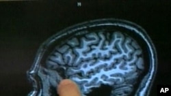 In lab tests, a new contrast agent highlighted the telltale protein deposits that are characteristic of Alzheimer's disease.